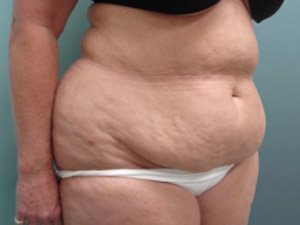Tummy Tuck | 360 Body Lift Before and After case 18