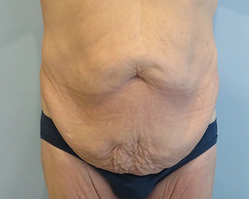 Tummy Tuck | 360 Body Lift Before and After case 4