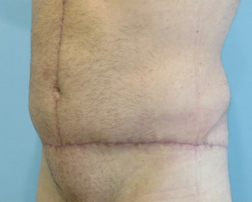 Tummy Tuck | 360 Body Lift Before and After case 4