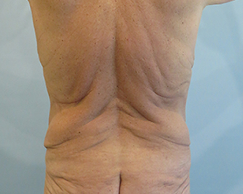 Tummy Tuck | 360 Body Lift Before and After case 4