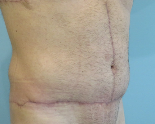 Tummy Tuck | 360 Body Lift Before and After case 4