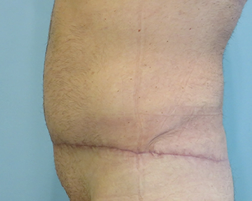 Tummy Tuck | 360 Body Lift Before and After case 4