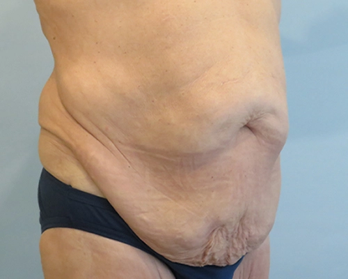 Tummy Tuck | 360 Body Lift Before and After case 4