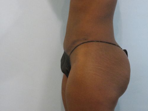 Tummy Tuck | 360 Body Lift Before and After case 5