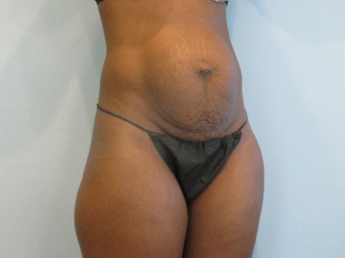 Tummy Tuck | 360 Body Lift Before and After case 5
