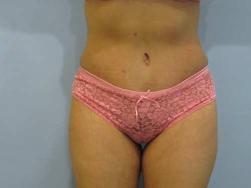 Tummy Tuck | 360 Body Lift Before & After case 6