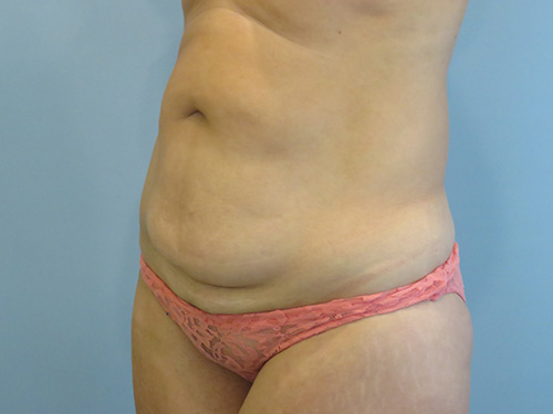 Tummy Tuck | 360 Body Lift Before and After case 9