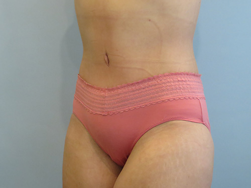 Tummy Tuck | 360 Body Lift Before and After case 9