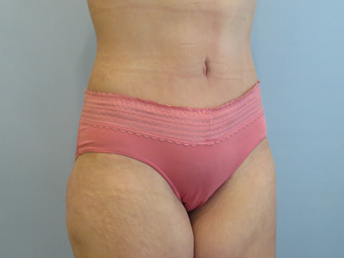 Tummy Tuck | 360 Body Lift Before and After case 9