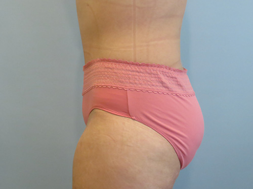 Tummy Tuck | 360 Body Lift Before and After case 9