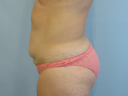 Tummy Tuck | 360 Body Lift Before and After case 9