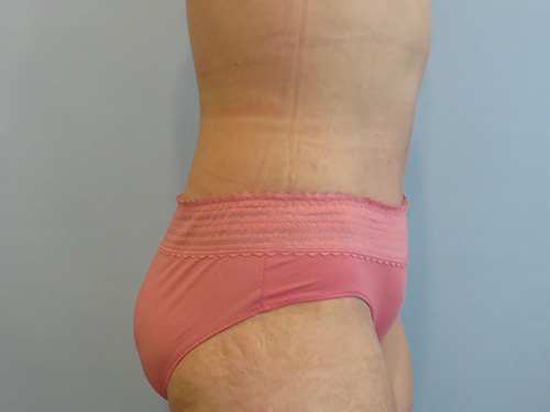 Tummy Tuck | 360 Body Lift Before and After case 9