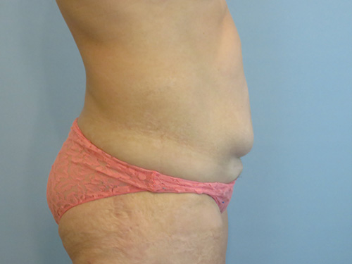 Tummy Tuck | 360 Body Lift Before and After case 9
