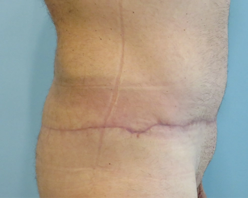 Tummy Tuck Before & After Case 1