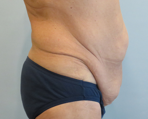 Tummy Tuck Before & After Case 1