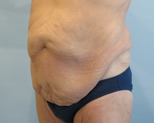 Tummy Tuck Before & After Case 1