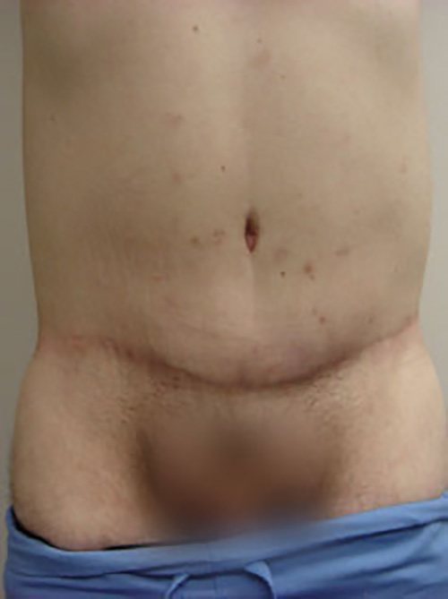 Tummy Tuck Before & After Case 2