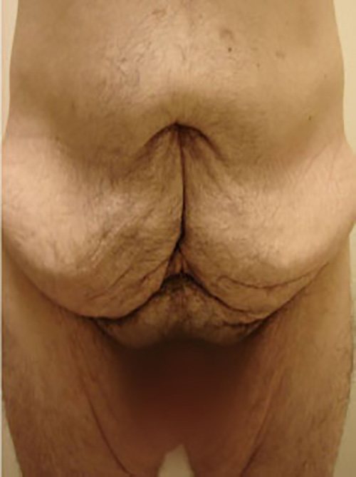 Tummy Tuck Before & After Case 2