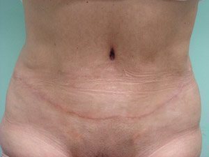Tummy Tuck | 360 Body Lift Before & After case 16