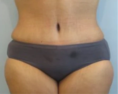Patient's abdomen and lower body after liposuction, showing improved contour and definition
