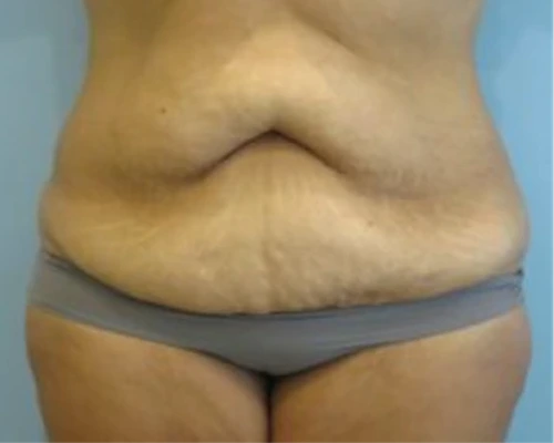 Patient's abdomen before liposuction, showing excess skin and fat around midsection