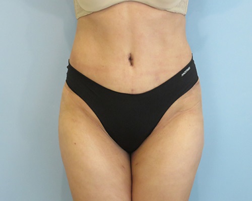 Patient's abdomen and torso showing results after mommy makeover procedure