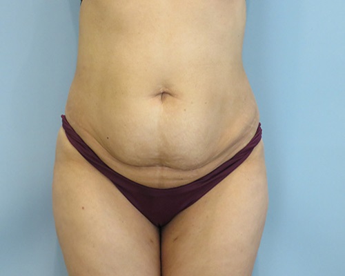 Patient's abdomen after mommy makeover surgery showing improved contour and skin tightness