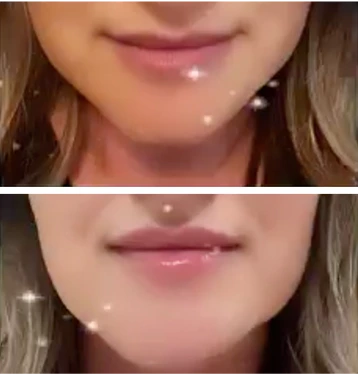 Before-and-after comparison of lips showing added volume and contour