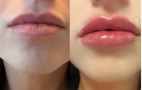 Before-and-after comparison of lips showing increased volume and fullness