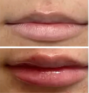 Before-and-after comparison of lips showing enhanced plumpness and definition