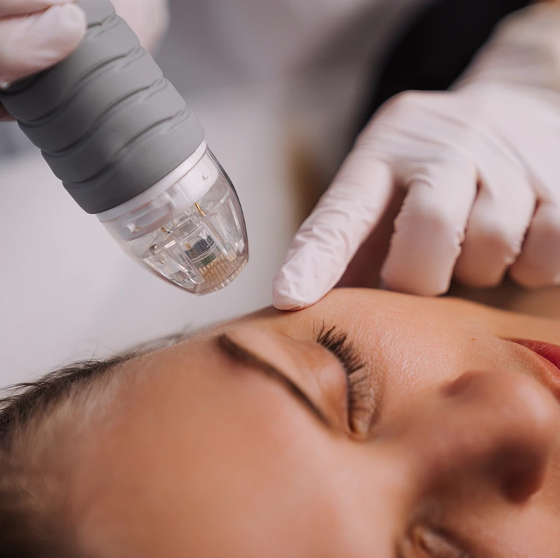 Practitioner applying microneedling device to patient's forehead during facial treatment