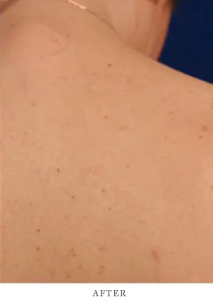 Case 1 after