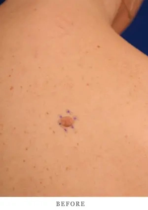 Case 1 before