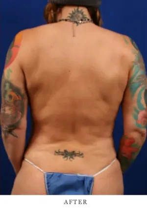 Case 1 lipo after