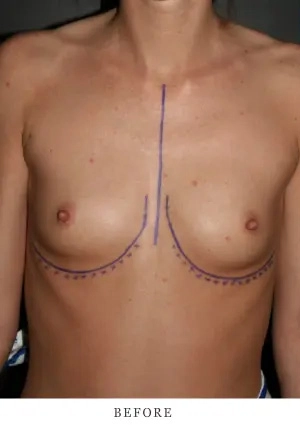 Patient's chest before breast augmentation with surgical markings, front view against gray background
