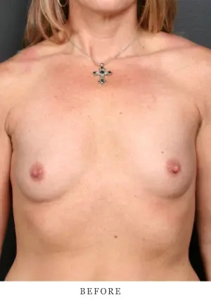 Front torso view before treatment showing uneven skin appearance
