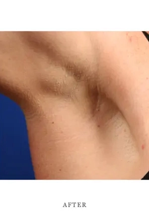 Close-up of underarm area showing smooth skin after treatment