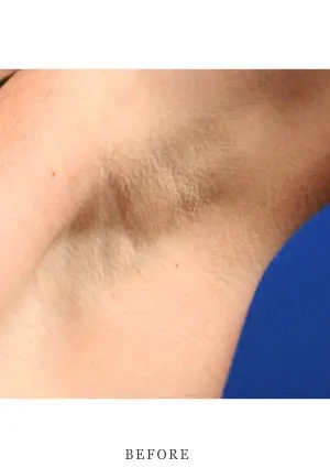 Close-up of underarm area showing visible veins before treatment
