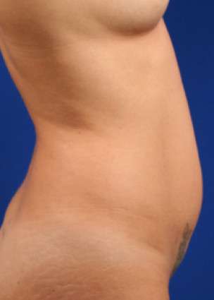 Case 2.1 vaser lipo before