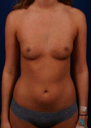 Case 23 before