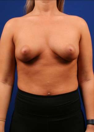Case 25 before