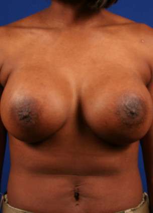 Case 29 after