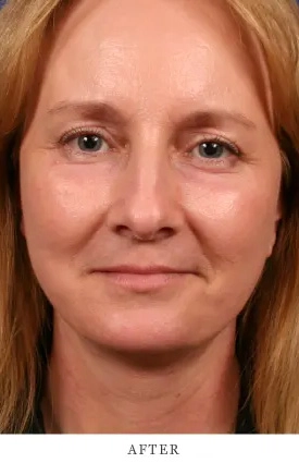 Case 4 after