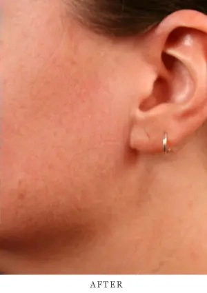 Case 4.1 after