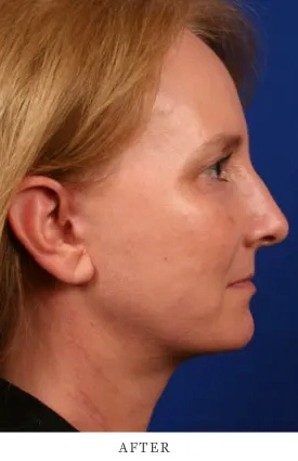 Case 4.1 after