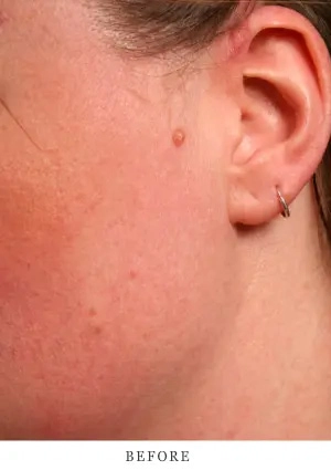 Case 4.1 before