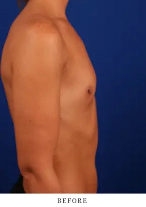 Before photo: patient side view against blue background