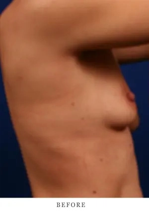 Patient torso before breast augmentation procedure, lateral view