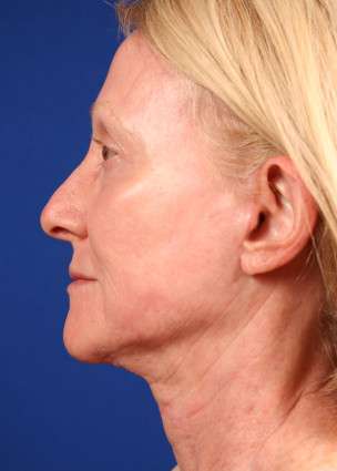 Face Case 1.2 after