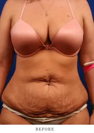 Tummy 1